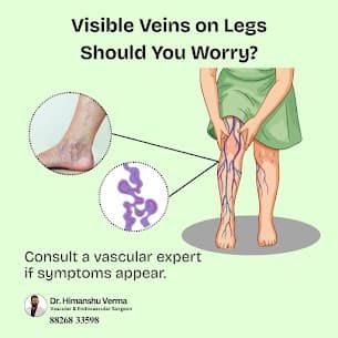 varicose veins treatment in Gurgaon