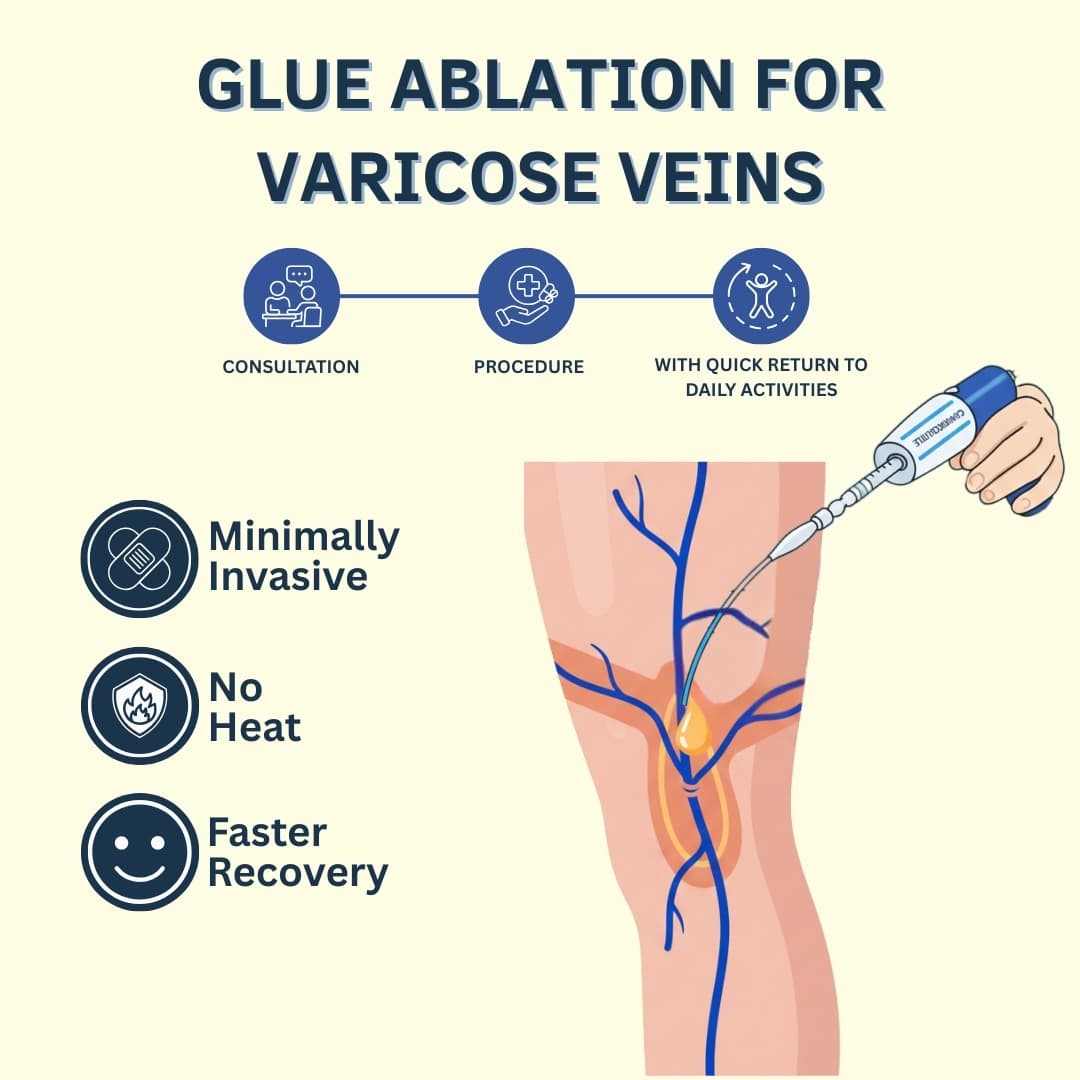 varicose veins treatment in Gurgaon