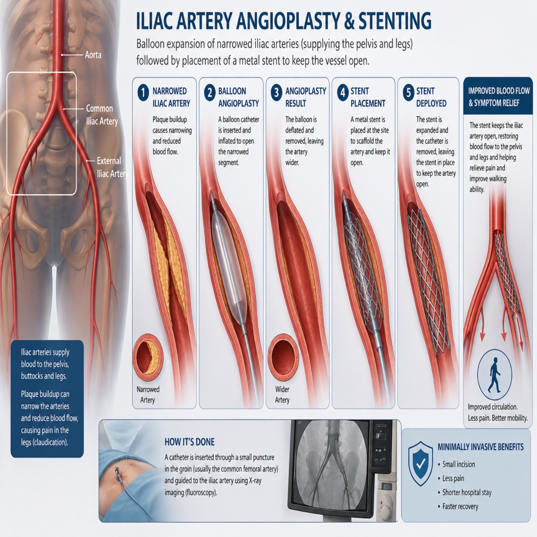 Peripheral Artery Disease treatment in Gurgaon